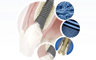 Dantų implantacija: žmonių baimės, ilgaamžiškumas ir garantijos