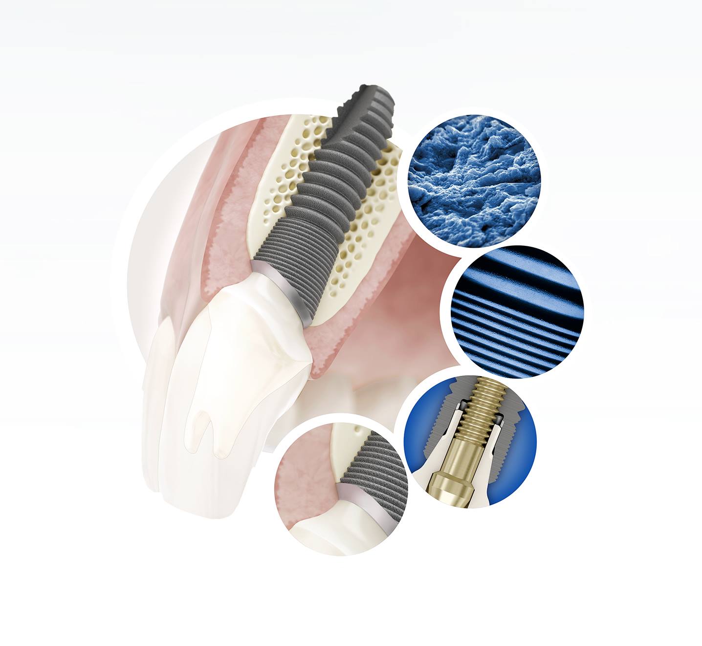 dantų implantas kaule