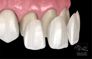 dantu laminatės cementuojamos ant minimaliai šlifuotų dantų